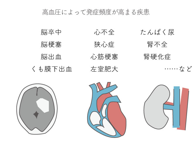 10-5本態性高血圧と心臓血管系の合併症から、高血圧によって発症頻度が高まる疾患抜き出し